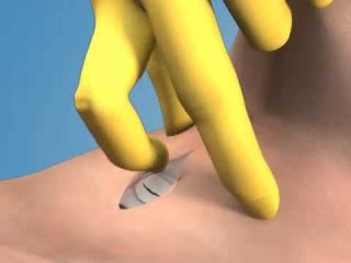 Крикотиротомия коникотомия 3D  компьютерная анимация
